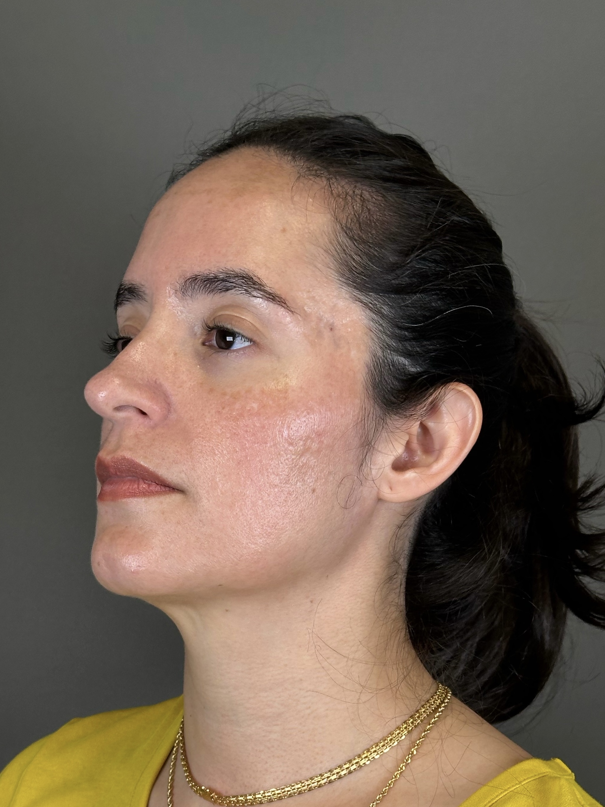 Microneedling with SkinPen Before & After Gallery - Patient 126847 - Image 5