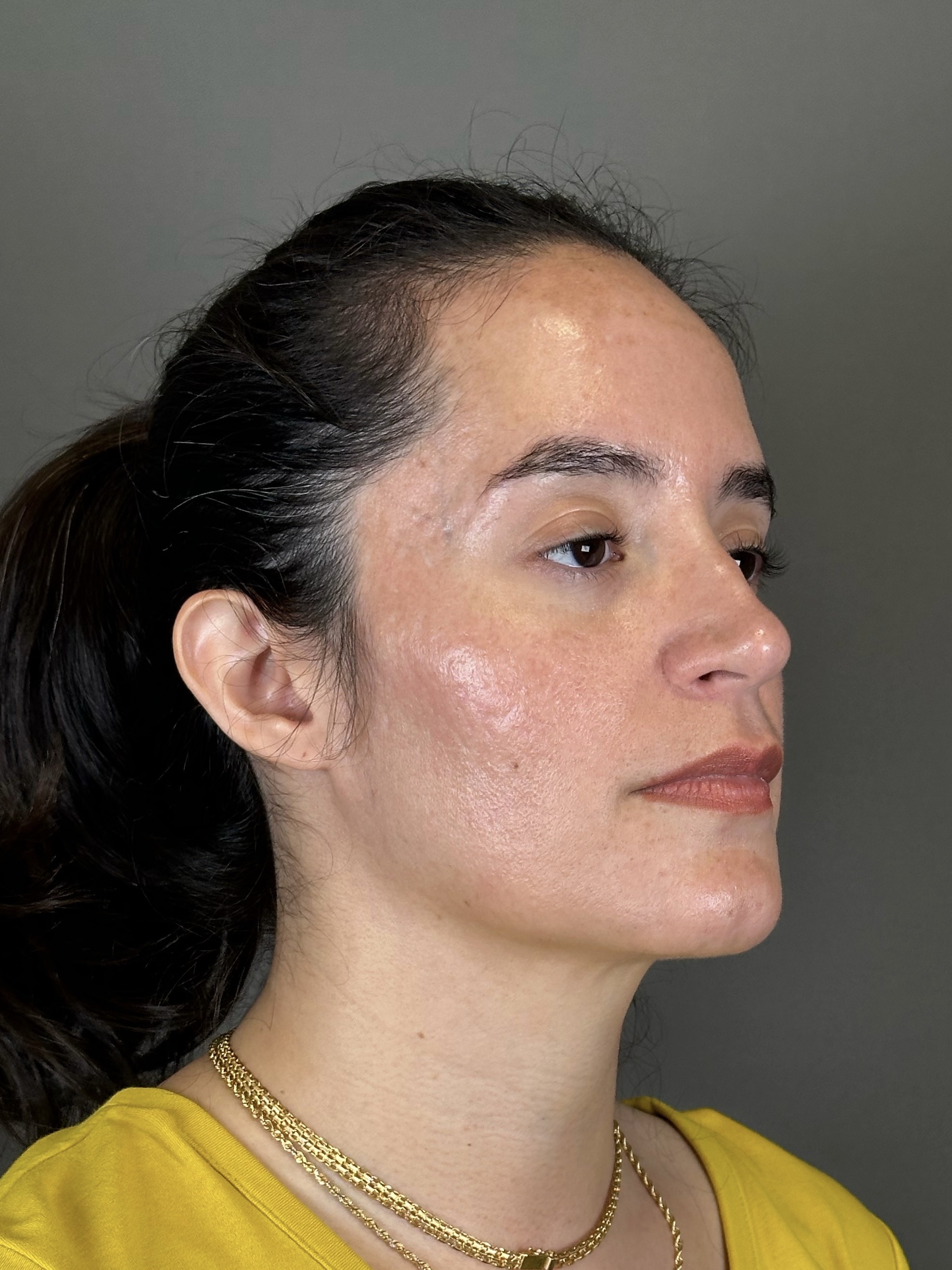 Microneedling with SkinPen Before & After Gallery - Patient 126847 - Image 3