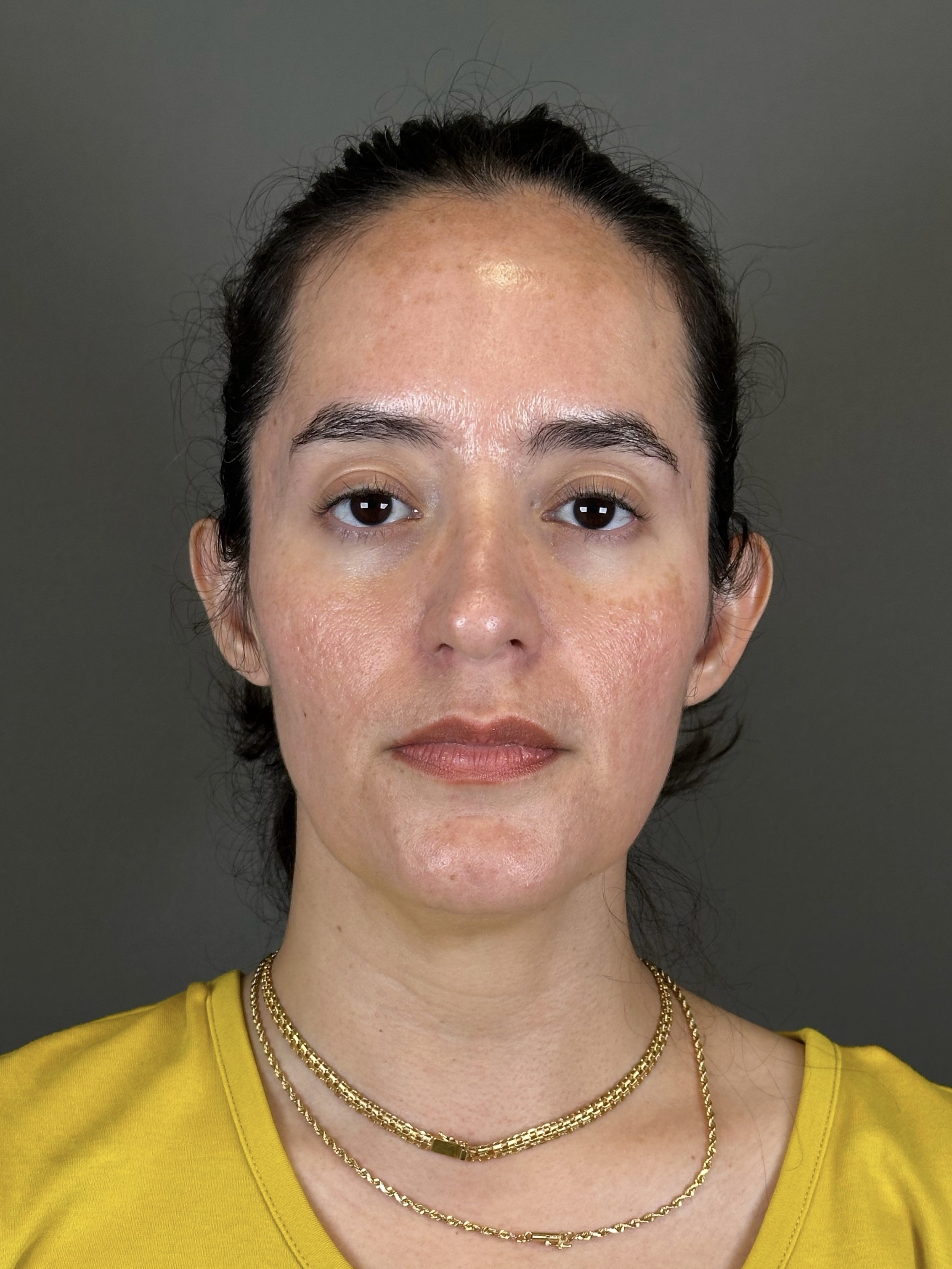 Microneedling with SkinPen Before & After Gallery - Patient 126847 - Image 1