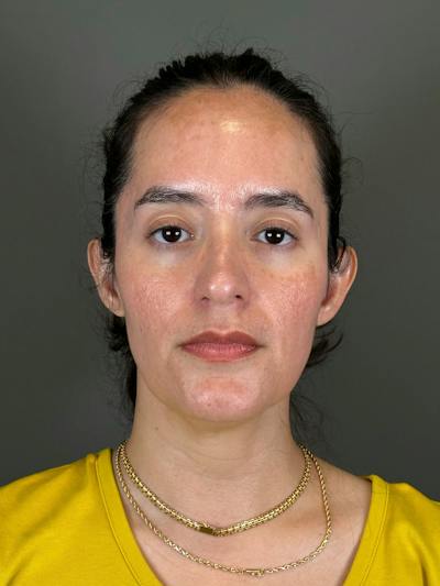 Microneedling with SkinPen Before & After Gallery - Patient 126847 - Image 1