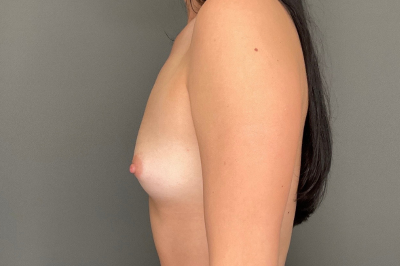 Breast Augmentation Before & After Gallery - Patient 247477 - Image 9