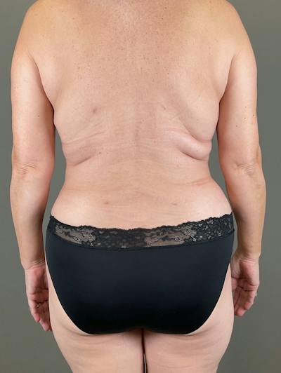 Liposuction Before & After Gallery - Patient 581962 - Image 6