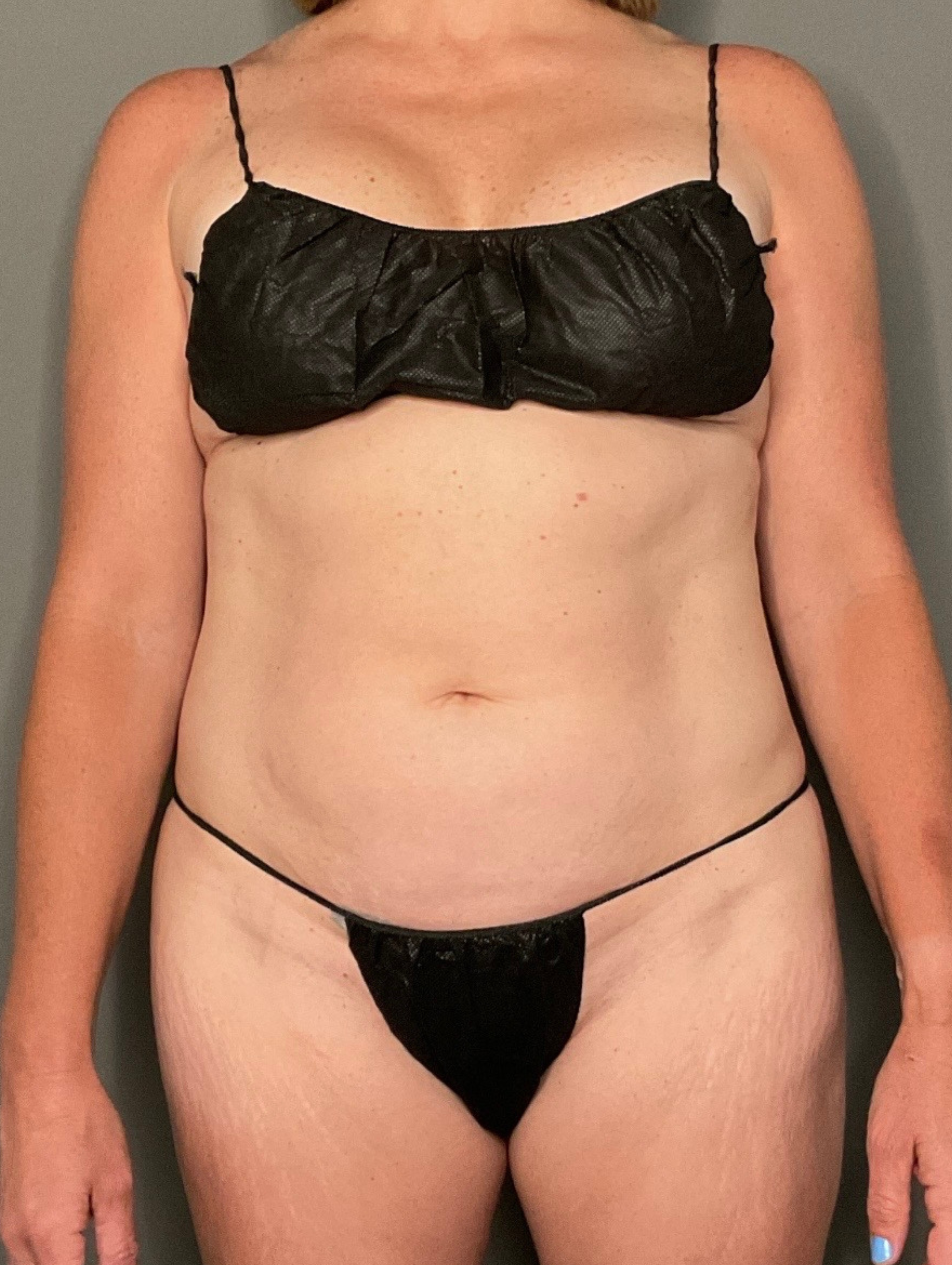 Tummy Tuck (Abdominoplasty) Before & After Gallery - Patient 257882 - Image 1