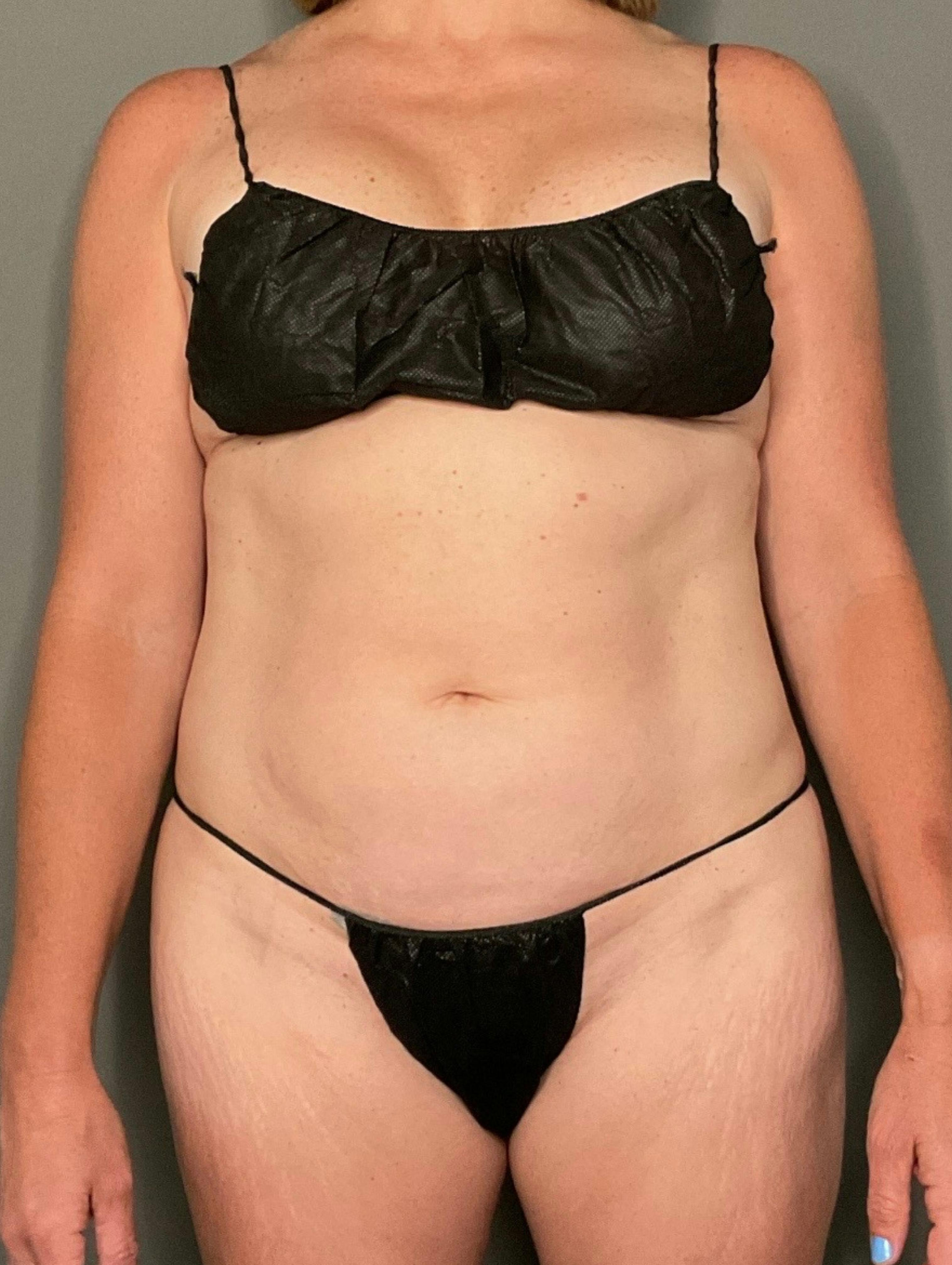 Tummy Tuck (Abdominoplasty)  Before & After Gallery - Patient 257882 - Image 1