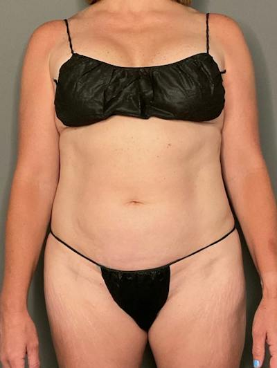 Tummy Tuck (Abdominoplasty)  Before & After Gallery - Patient 257882 - Image 1