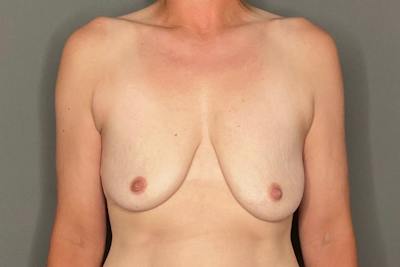 Breast Augmentation Before & After Gallery - Patient 155764 - Image 1