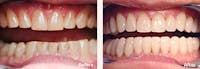 Full Mouth Reconstruction Before & After Gallery - Patient 9747002 - Image 1