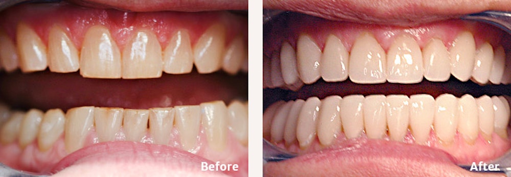 Full Mouth Reconstruction
