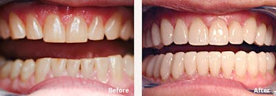Full Mouth Reconstruction Before & After Gallery - Patient 9747002 - Image 1