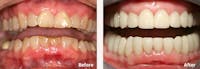 Full Mouth Reconstruction Before & After Gallery - Patient 9747003 - Image 1