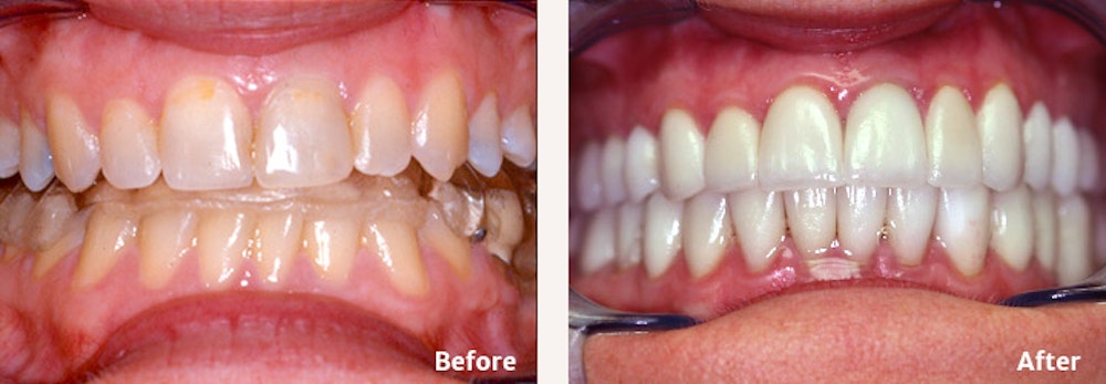 Full Mouth Reconstruction