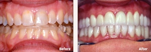 Full Mouth Reconstruction