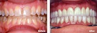 Full Mouth Reconstruction Before & After Gallery - Patient 9747004 - Image 1