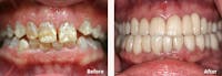 Full Mouth Reconstruction Before & After Gallery - Patient 9747005 - Image 1
