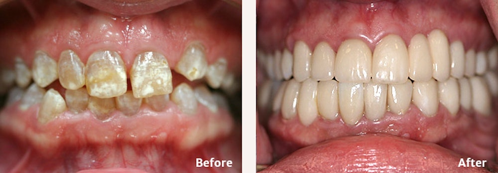Full Mouth Reconstruction
