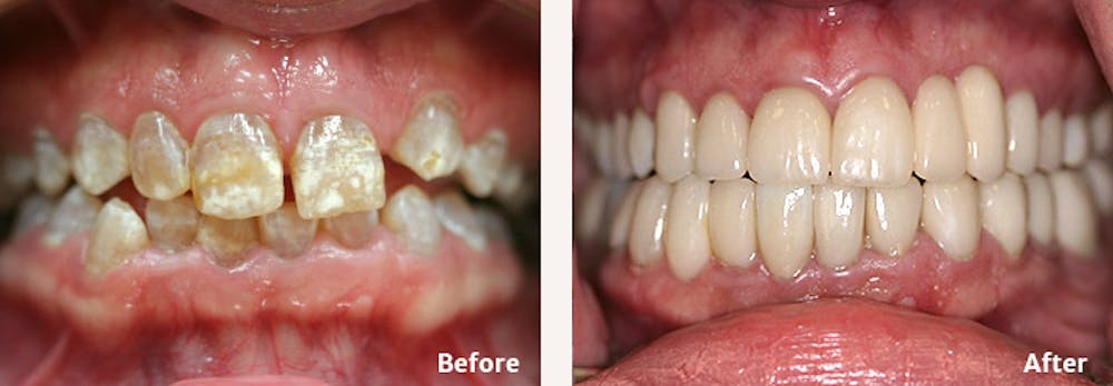 Full Mouth Reconstruction Gallery - Patient 9747005 - Image 1
