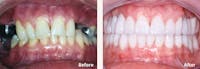 Full Mouth Reconstruction Before & After Gallery - Patient 9747006 - Image 1
