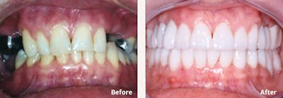 Dental Implants