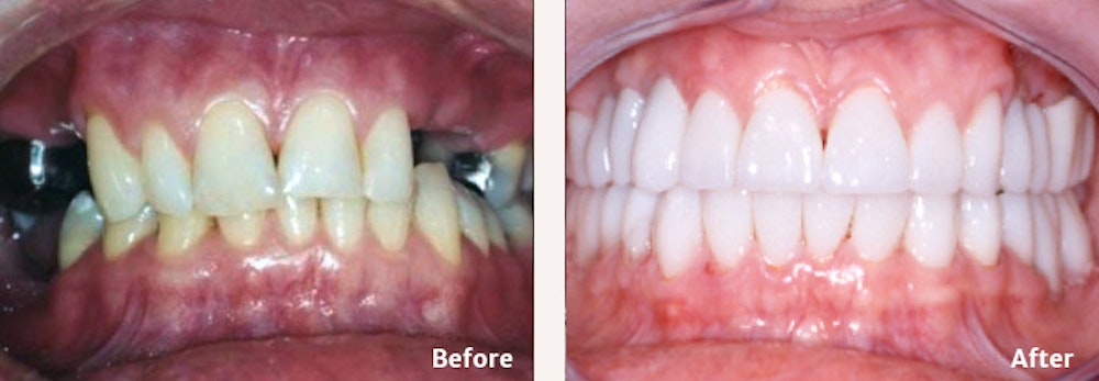 Full Mouth Reconstruction