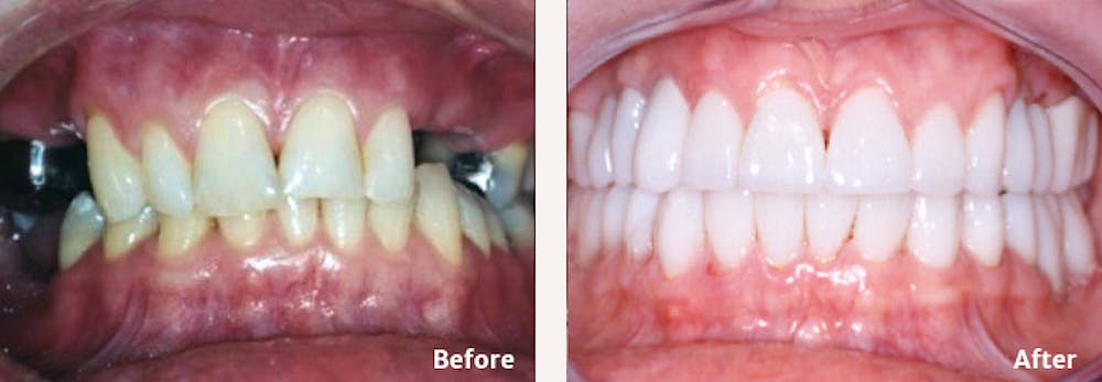 Full Mouth Reconstruction Before & After Gallery - Patient 9747006 - Image 1
