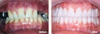 Full Mouth Reconstruction Gallery - Patient 9747006 - Image 1