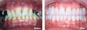 Dental Implants