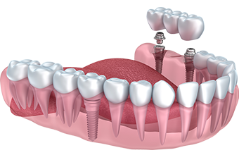 Infographic of Implants