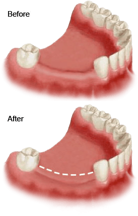 Before and After Bone Grafting