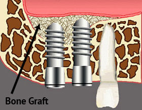 Bone Grafting Infographic