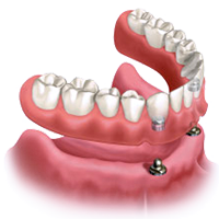Dentures