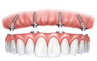 Implant Infographic