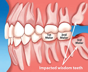 Wisdom teeth diagram