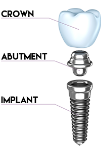 Dental Implant Infographic