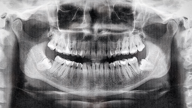 Panoramic X-Rays