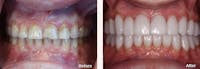 Full Mouth Reconstruction Before & After Gallery - Patient 24397946 - Image 1