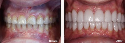 Full Mouth Reconstruction Before & After Gallery - Patient 24397946 - Image 1