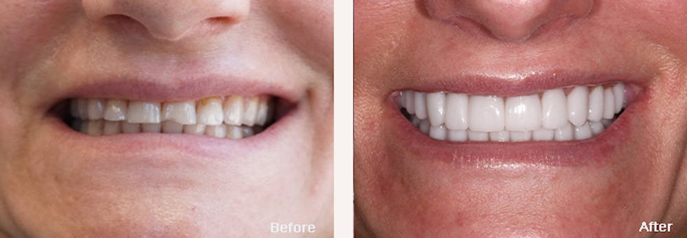 Full Mouth Reconstruction Before & After Gallery - Patient 24397946 - Image 2