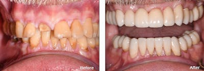Dental Implants
