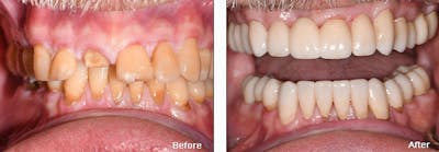 Full Mouth Reconstruction Before & After Gallery - Patient 25280958 - Image 1