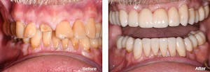 Dental Implants
