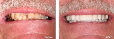 Full Mouth Reconstruction Before & After Gallery - Patient 25280958 - Image 2