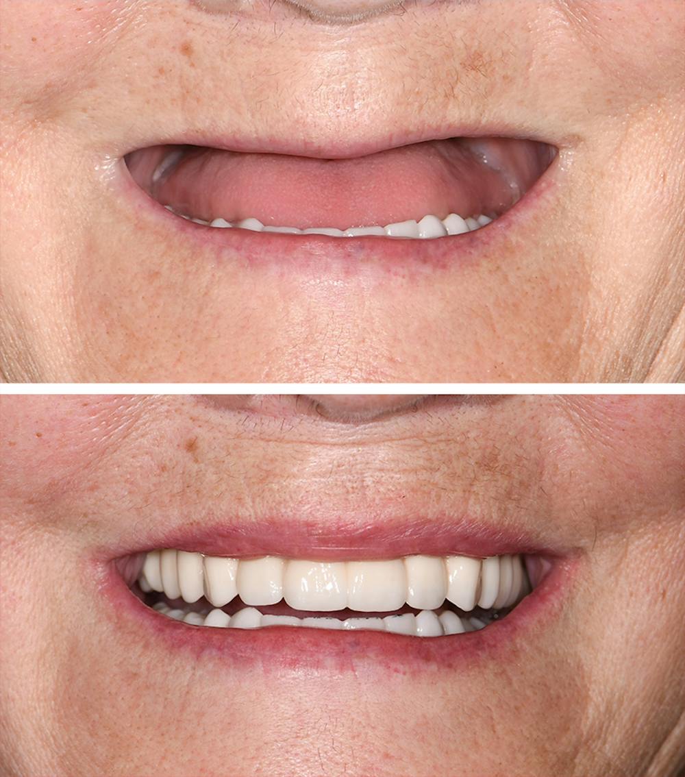 Full Mouth Reconstruction Before & After Gallery - Patient 225662 - Image 1
