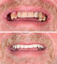 Full Mouth Reconstruction Before & After Gallery - Patient 381926 - Image 1