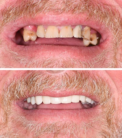 Full Mouth Reconstruction Before & After Gallery - Patient 381926 - Image 1