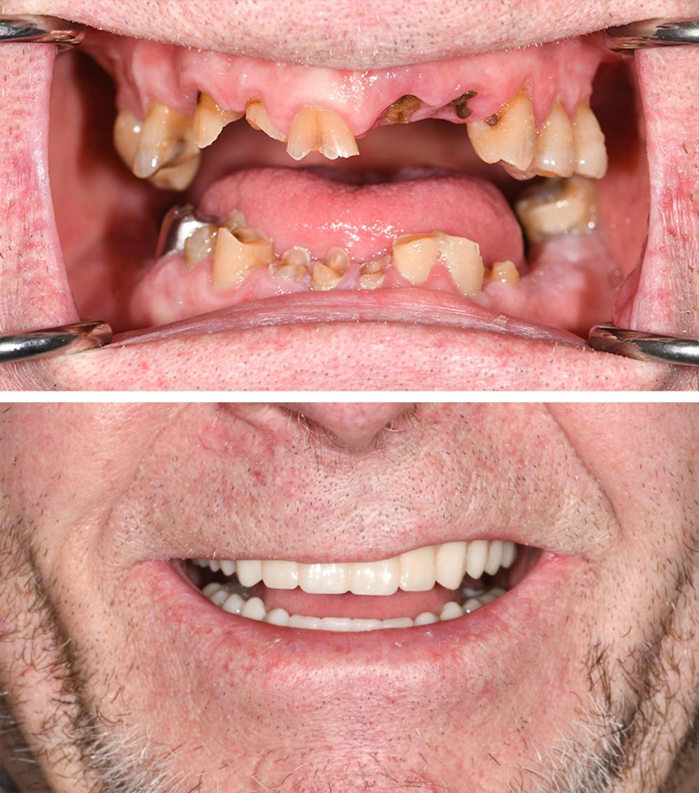 Full Mouth Reconstruction Before & After Gallery - Patient 288026 - Image 1