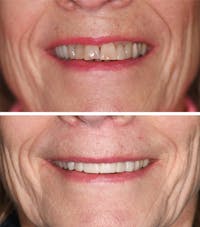 Full Mouth Reconstruction Before & After Gallery - Patient 158236 - Image 1