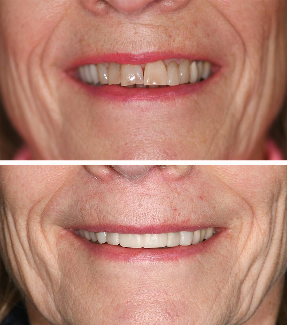 Full Mouth Reconstruction Before & After Gallery - Patient 158236 - Image 1