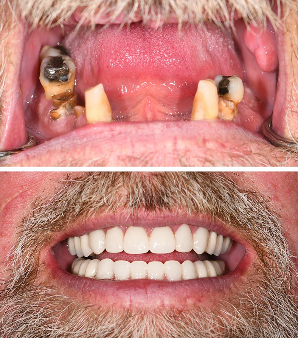 Full Mouth Reconstruction Before & After Gallery - Patient 273519 - Image 1