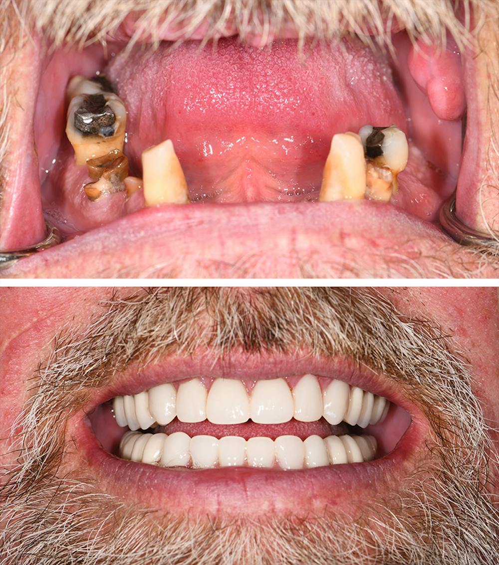 Full Mouth Reconstruction Before & After Gallery - Patient 273519 - Image 1