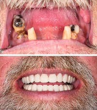 Full Mouth Reconstruction Before & After Gallery - Patient 273519 - Image 1